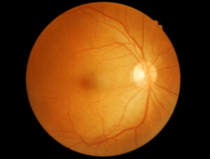 A retinal photograph showing early background changes. Small red dots are visible across the retina, representing tiny areas where blood vessels have leaked. 