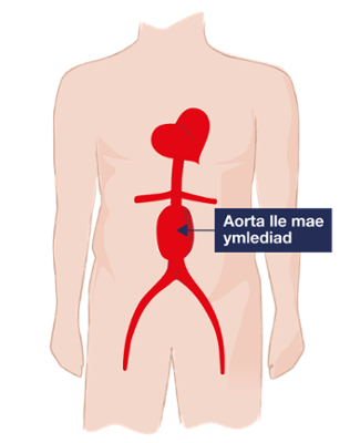 Darlun o gorff dynol yn amlygu'r rhan o'r bol, gyda saeth yn pwyntio at yr aorta sy'n dangos chwydd, gan nodi ymlediadau aortig abdomenol (YAA).