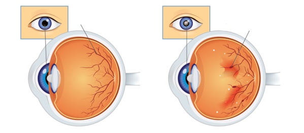 Image comparing a normal healthy eye with one with damage to the retina and leaking blood vessels"