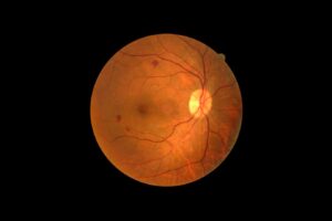 A retinal photograph showing several dark red blot-like patches on the retina, suggesting areas where blood has leaked from the vessels. The optic disc appears bright on the right side, and the retinal blood vessels radiate outward. A few scattered darker spots are visible across the orange-red retinal surface.