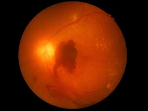 A retinal photograph showing a large dark red, cloud‑like area in the central retina, indicating a significant collection of blood. The bright optic disc is visible on the left, with retinal blood vessels radiating outward. Small pale speckled areas appear across parts of the retina, and the rest of the background has an orange‑red tone.