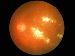Mae'r llun o'r retinol yn dangos adneuon melyn‑gwyn llachar wedi’u grwpio o amgylch canol y retina, gyda smotiau llai gwasgaredig gerllaw. Mae’r ddisg optegol ar yr ochr chwith yn ymddangos yn llachar, ac mae’r cefndir yn dangos arwyneb retina oren-goch arferol gyda phibellau gwaed.