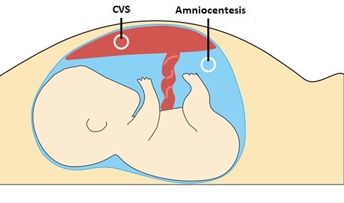 Diagram showing where chorionic villus sampling (CVS) and amniocentesis take samples during pregnancy.