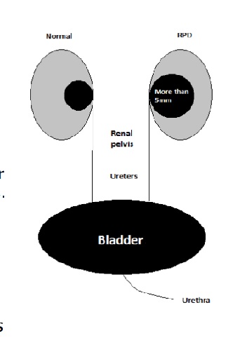 Diagram comparing a normal kidney and one with renal pelvis dilatation (RPD). The normal kidney shows a small central renal pelvis, while the RPD kidney shows an enlarged central area labelled “more than 5mm.” Both kidneys connect via ureters to a labelled bladder below, with the urethra shown extending downward.